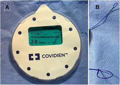 Unidirectional barbed sutures vs. interrupted intracorporeal knots in thoracoscopic repair of congenital diaphragmatic hernia in pediatrics